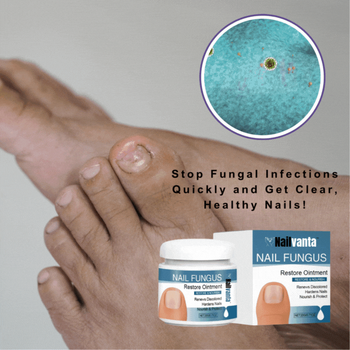 Nailvanta™ Nagel Schimmel Zalf | Stop schimmelinfecties snel en krijg heldere, gezonde nagels!