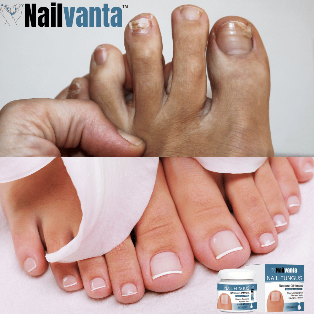 Nailvanta™ Nagel Schimmel Zalf | Stop schimmelinfecties snel en krijg heldere, gezonde nagels!