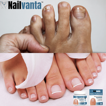 Nailvanta™ Nagel Schimmel Zalf | Stop schimmelinfecties snel en krijg heldere, gezonde nagels!