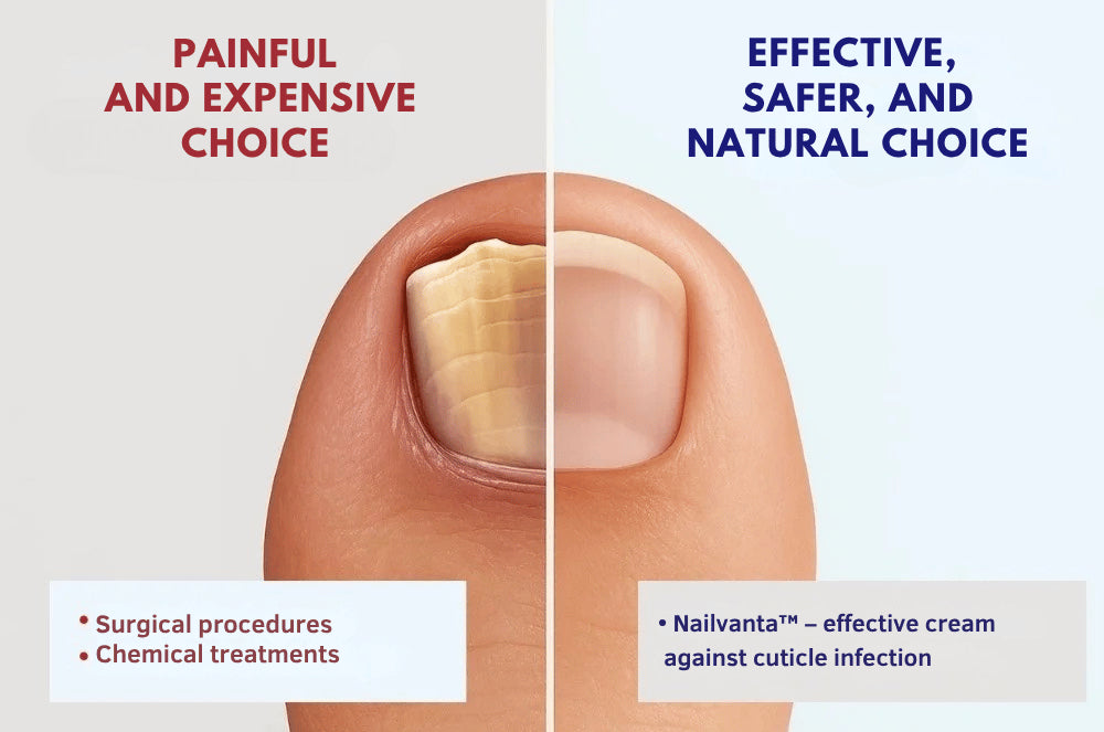 Nailvanta™ Nagel Schimmel Zalf | Stop schimmelinfecties snel en krijg heldere, gezonde nagels!