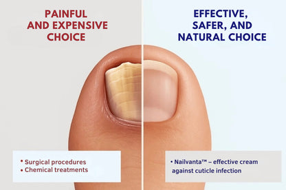 Nailvanta™ Nagel Schimmel Zalf | Stop schimmelinfecties snel en krijg heldere, gezonde nagels!